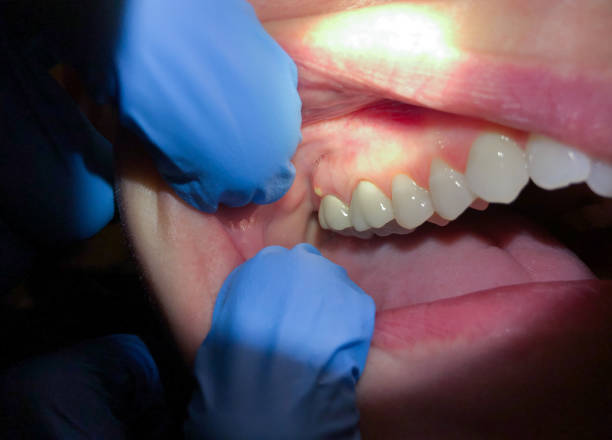 Best Emergency Dentist for Knocked-Out Tooth in Muhlenberg Rk, PA